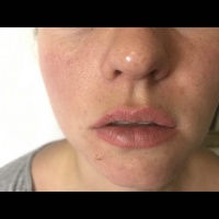 Lippenvergrößerung mit Hyaluronsäure  Foto