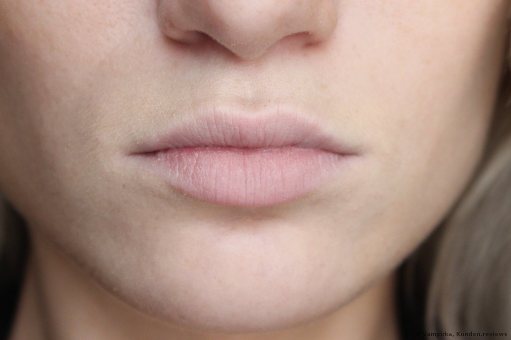 Lippenvergrößerung mit Hyaluronsäure  Foto