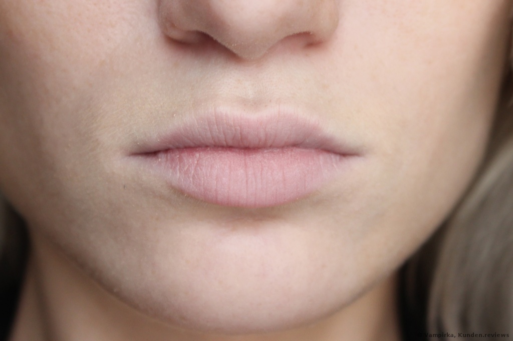 Lippenvergrosserung Mit Hyaluronsaure Vorher Nachher Fotos Wie Sehen Meine Lippen Nach 2 5 Jahren Aus Testberichte Bewertungen Meinungen