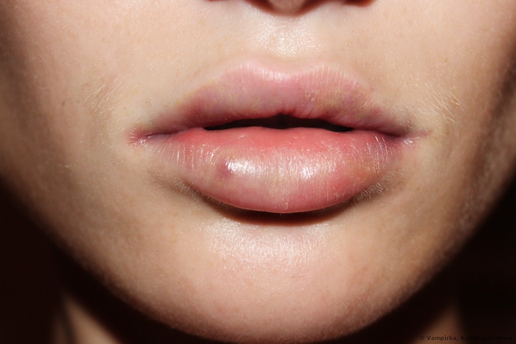 Lippenvergrößerung mit Hyaluronsäure 