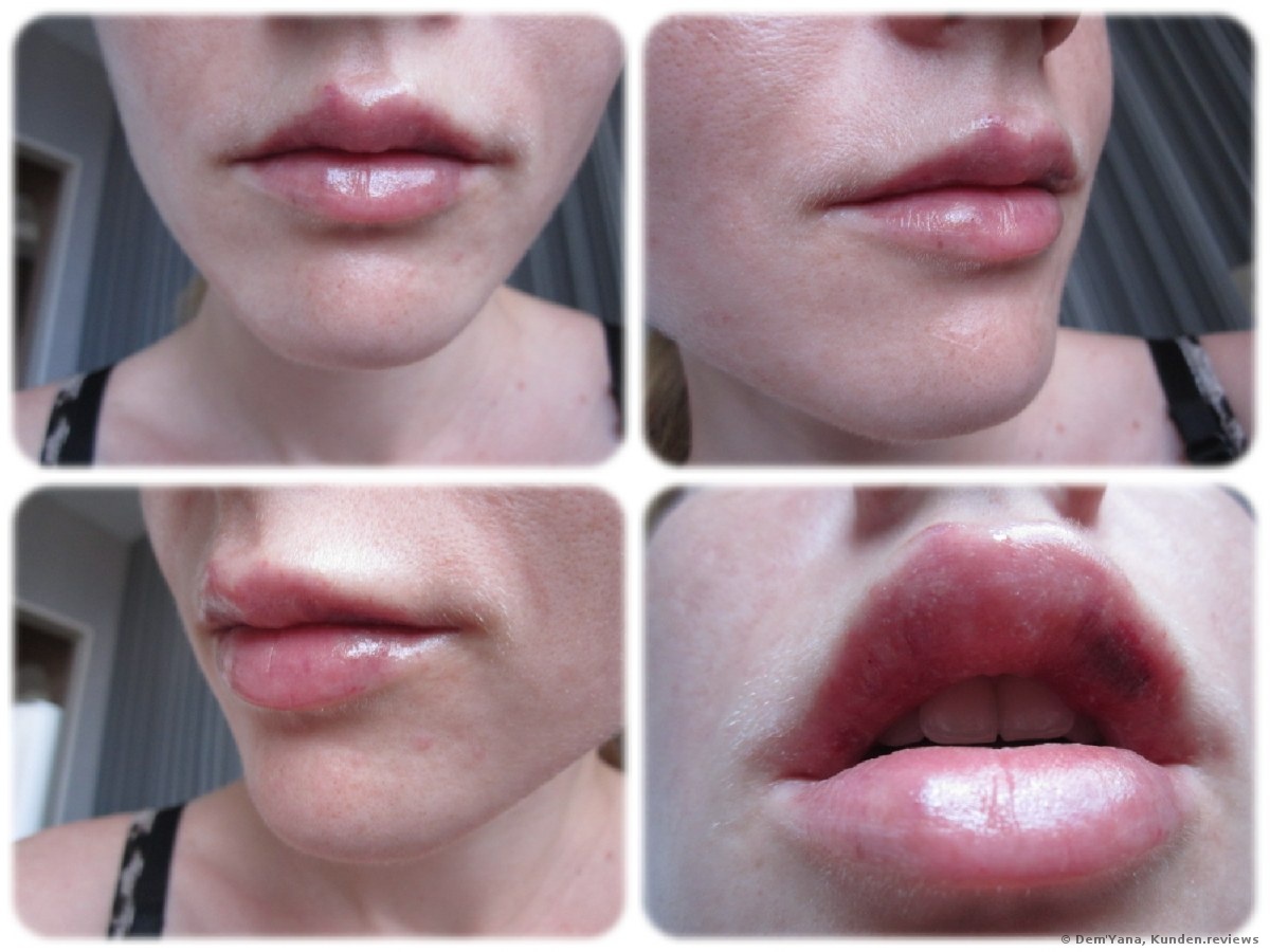 Lippenvergrößerung mit Juvederm Ultra 3