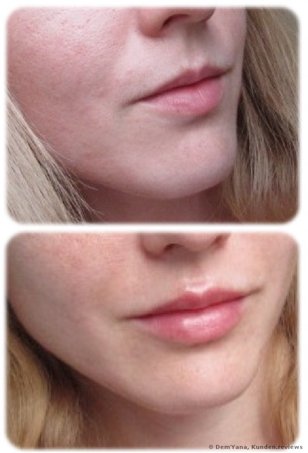 Lippenvergrößerung mit Juvederm Ultra 3