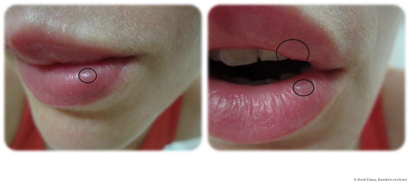 Lippenvergrößerung mit Juvederm Ultra 3