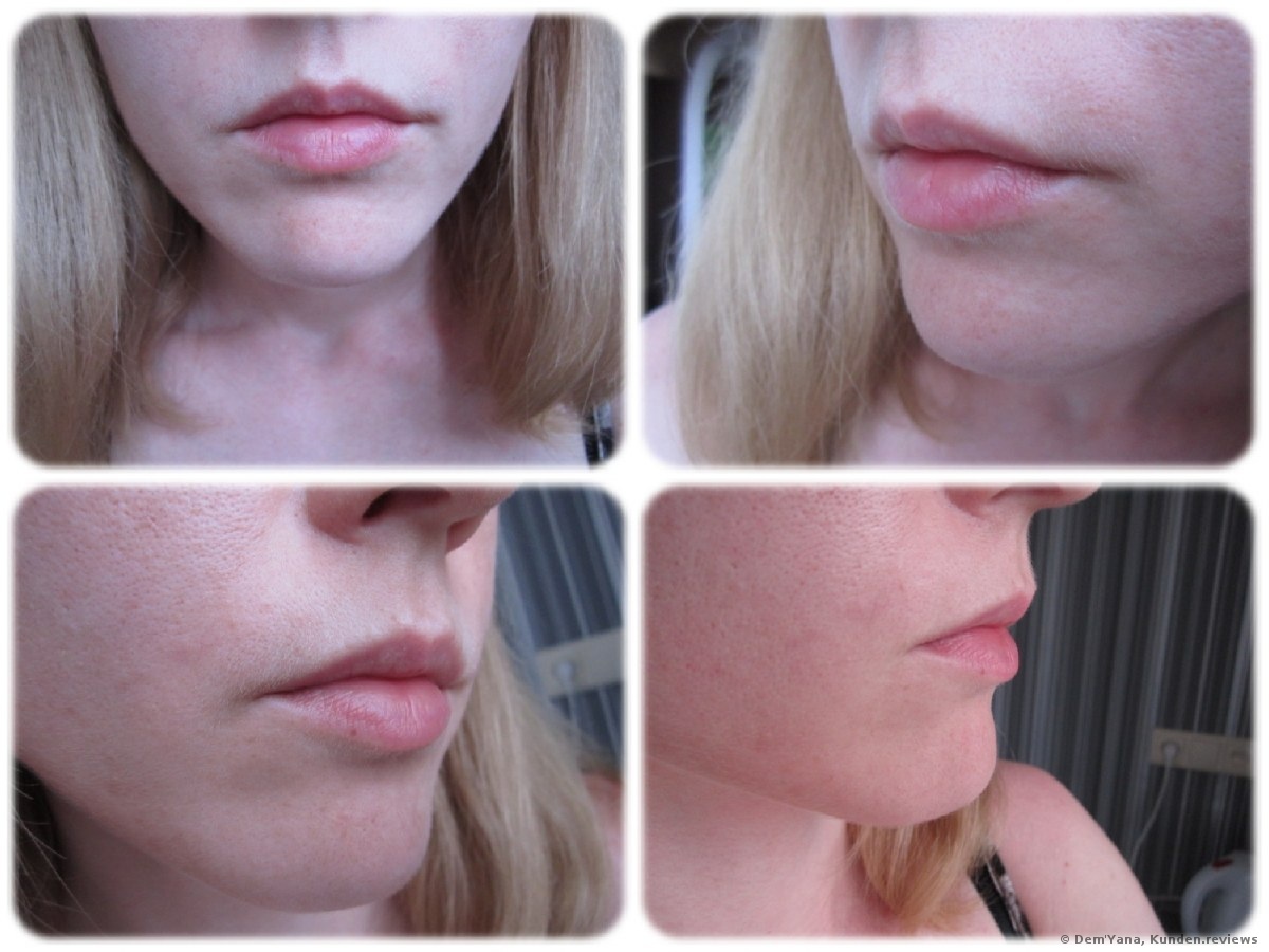 ohne Lippenvergrößerung mit Juvederm Ultra 3