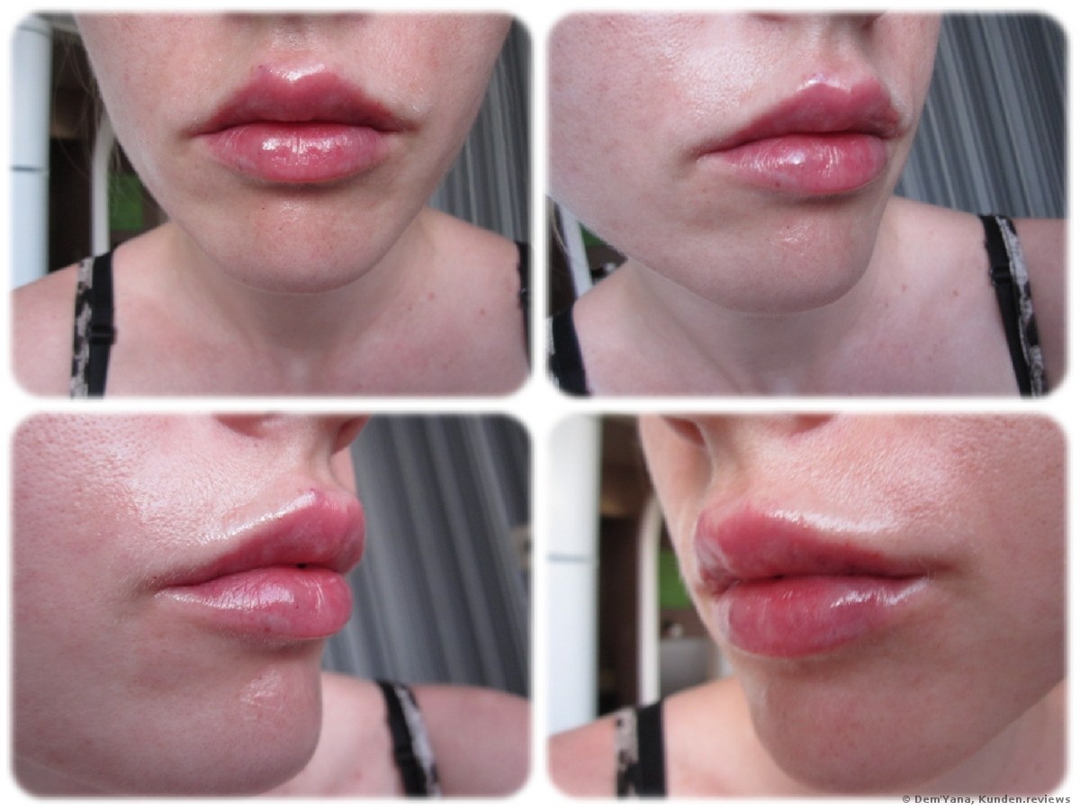 Lippenvergrößerung mit Juvederm Ultra 3