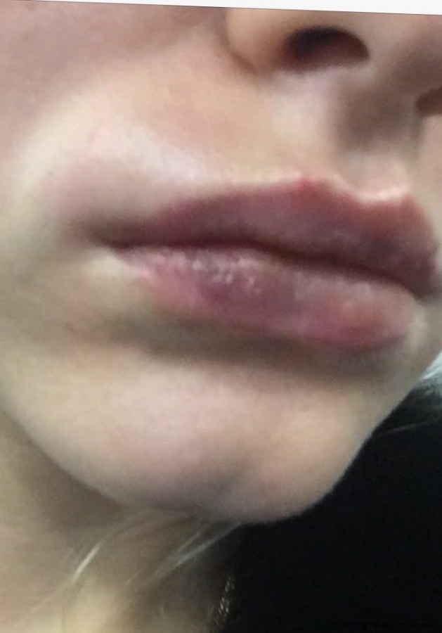 Die Lippenvergrößerung