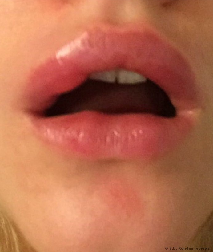 Die Lippenvergrößerung