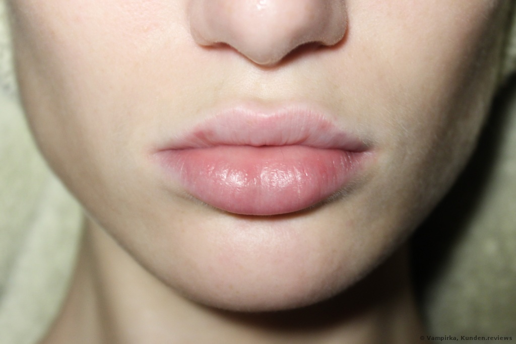 Wie sehen meine Lippen nach 2,5 Jahren aus? 